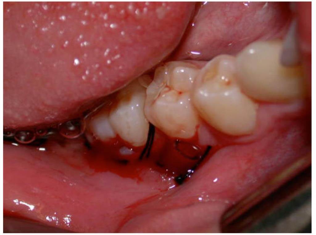 Костная пластика после лечения кисты зуба
