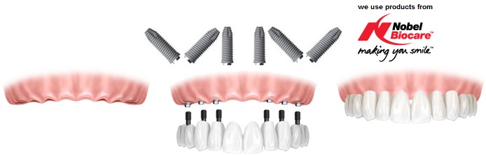Экспресс-имплантация зубов
