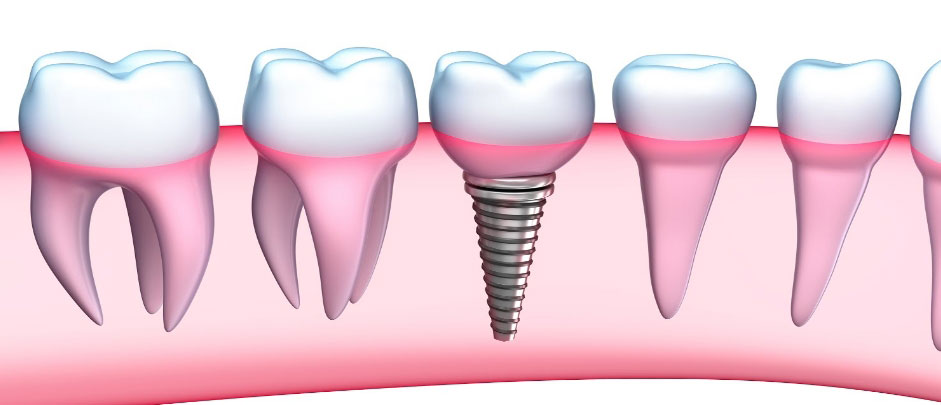 Имплант зуба
