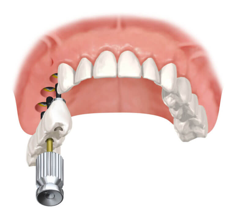 Имплантация части верхней челюсти