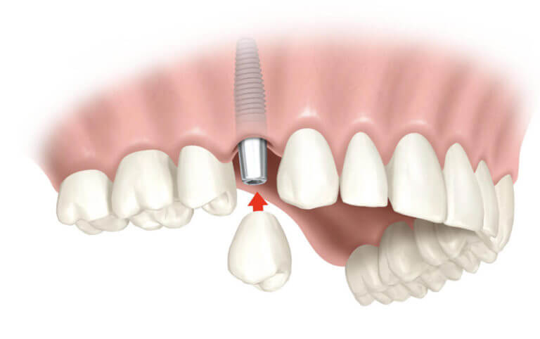 Имплантация зубов с отстроченной нагрузкой
