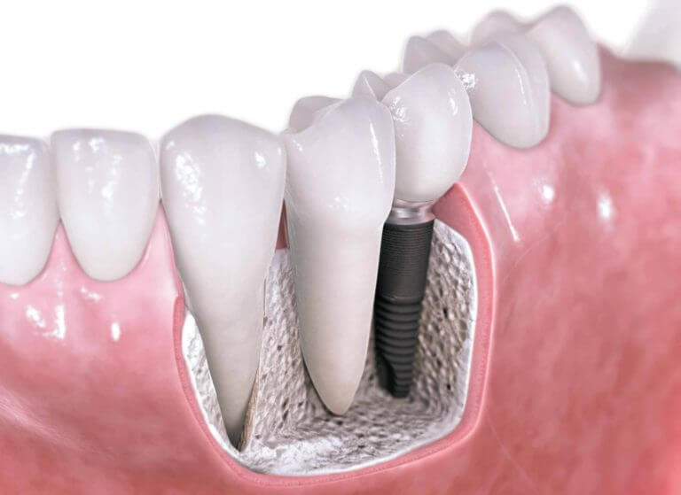 Комбинированная имплантация зубов