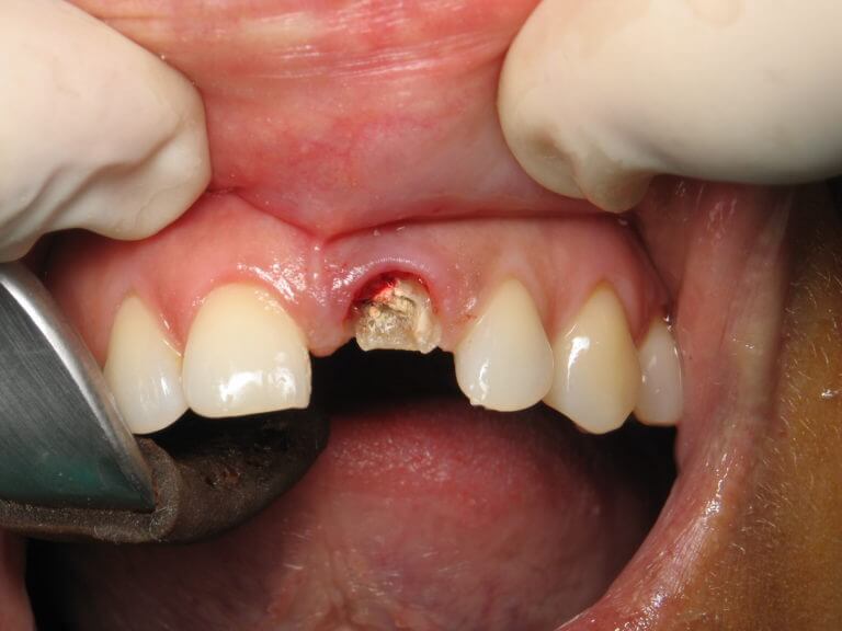Отсутствие переднего зуба