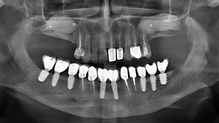 Рентген челюсти