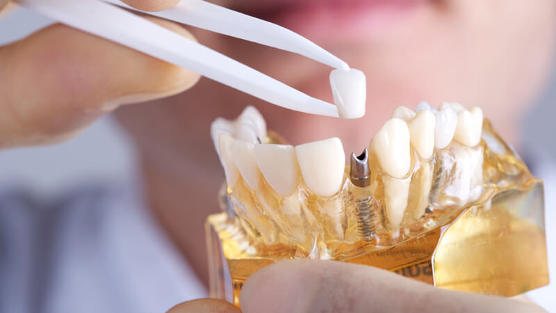 Восстановление зубного рядя